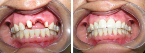 Tratamientos Servicios Dr Eduardo Estupiñan Odontologo Ibague